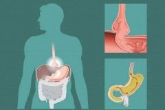 ������ʳ���װ����ġ�������ô�ַ��ˣ���ҽ��ν�����ʳָ����